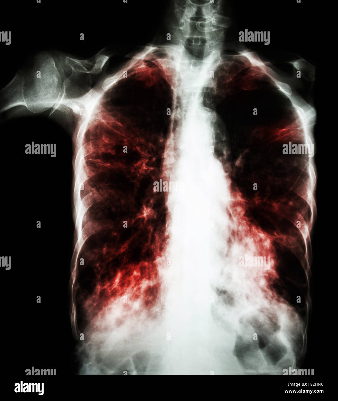 Pulmonary Tuberculosis ( film chest x-ray : interstitial infiltrate