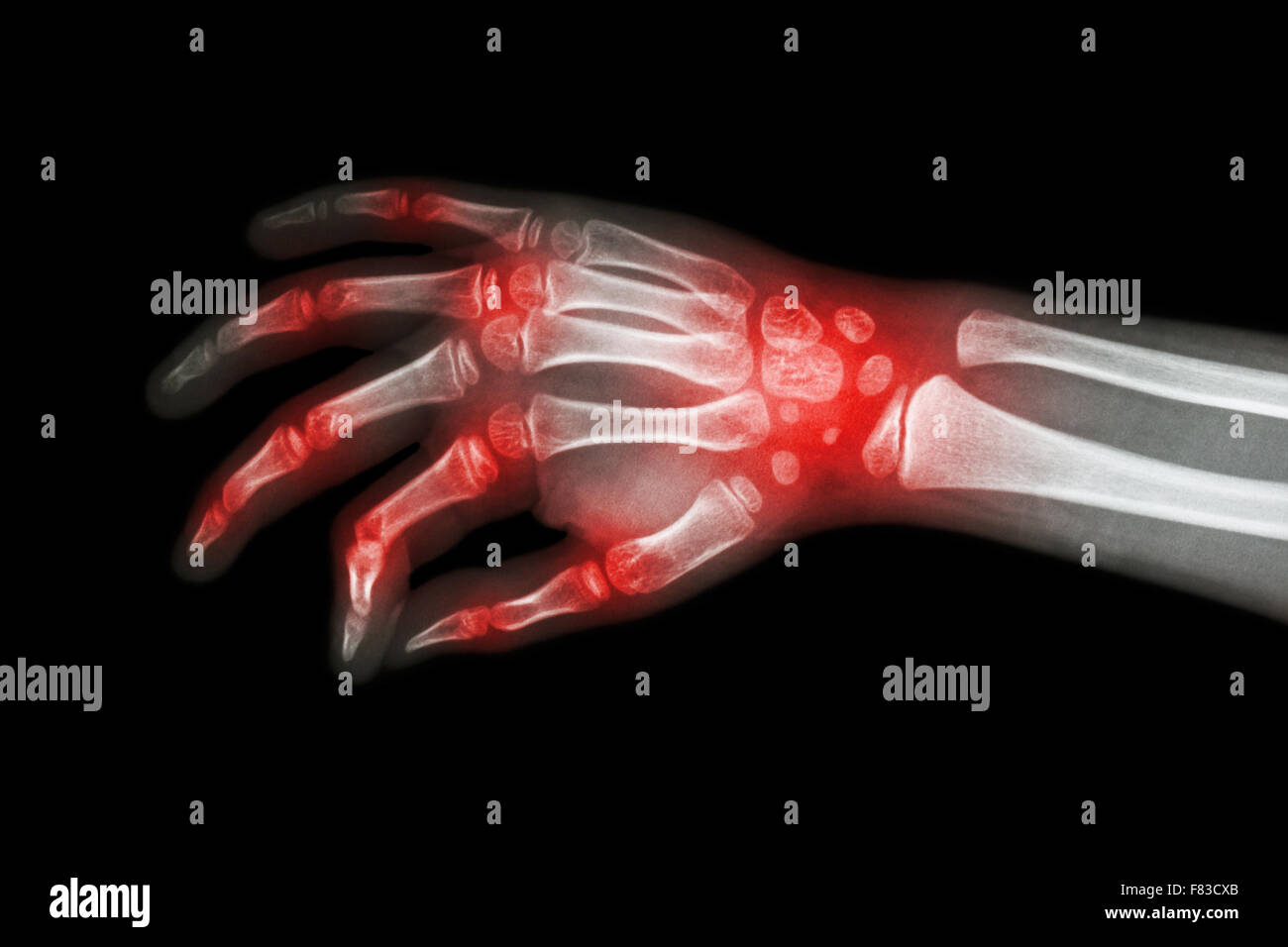 Rheumatoid arthritis , Gouty arthritis ( Film x-ray hand of child with arthritis at multiple joint ) Stock Photo