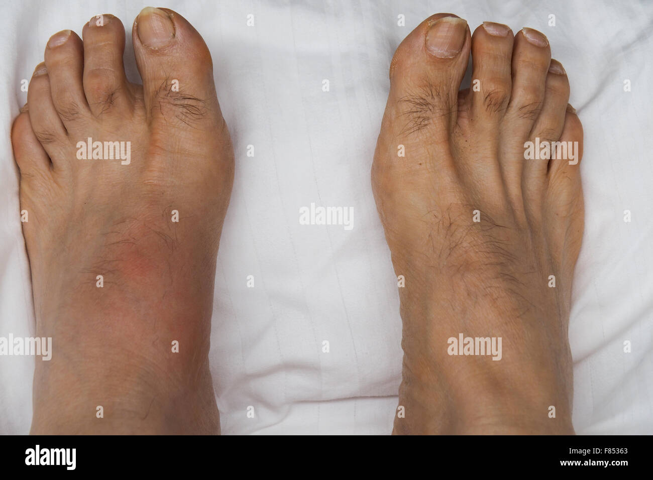 A pair of feet with the left foot inflamed and swollen with gout Stock