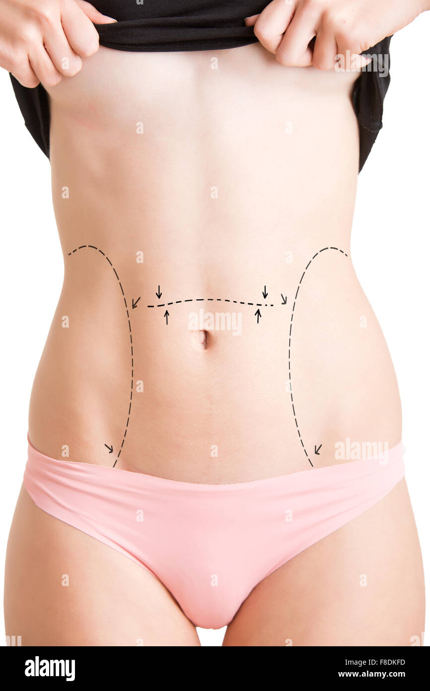 Tummy marked for plastic surgery, isolated in white Stock Photo