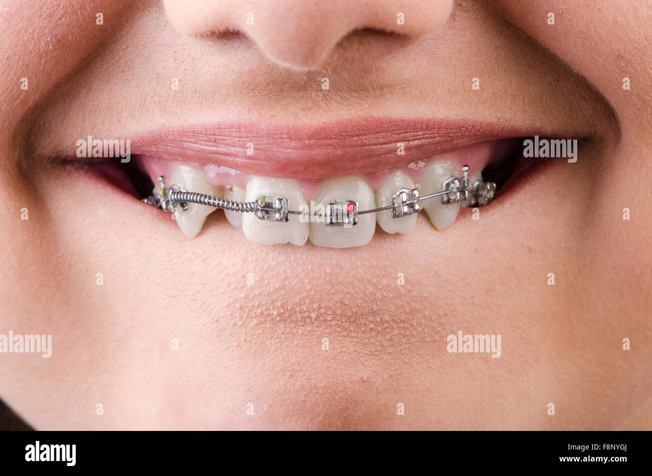 Mouth with brackets braces in medical concept Stock Photo Alamy