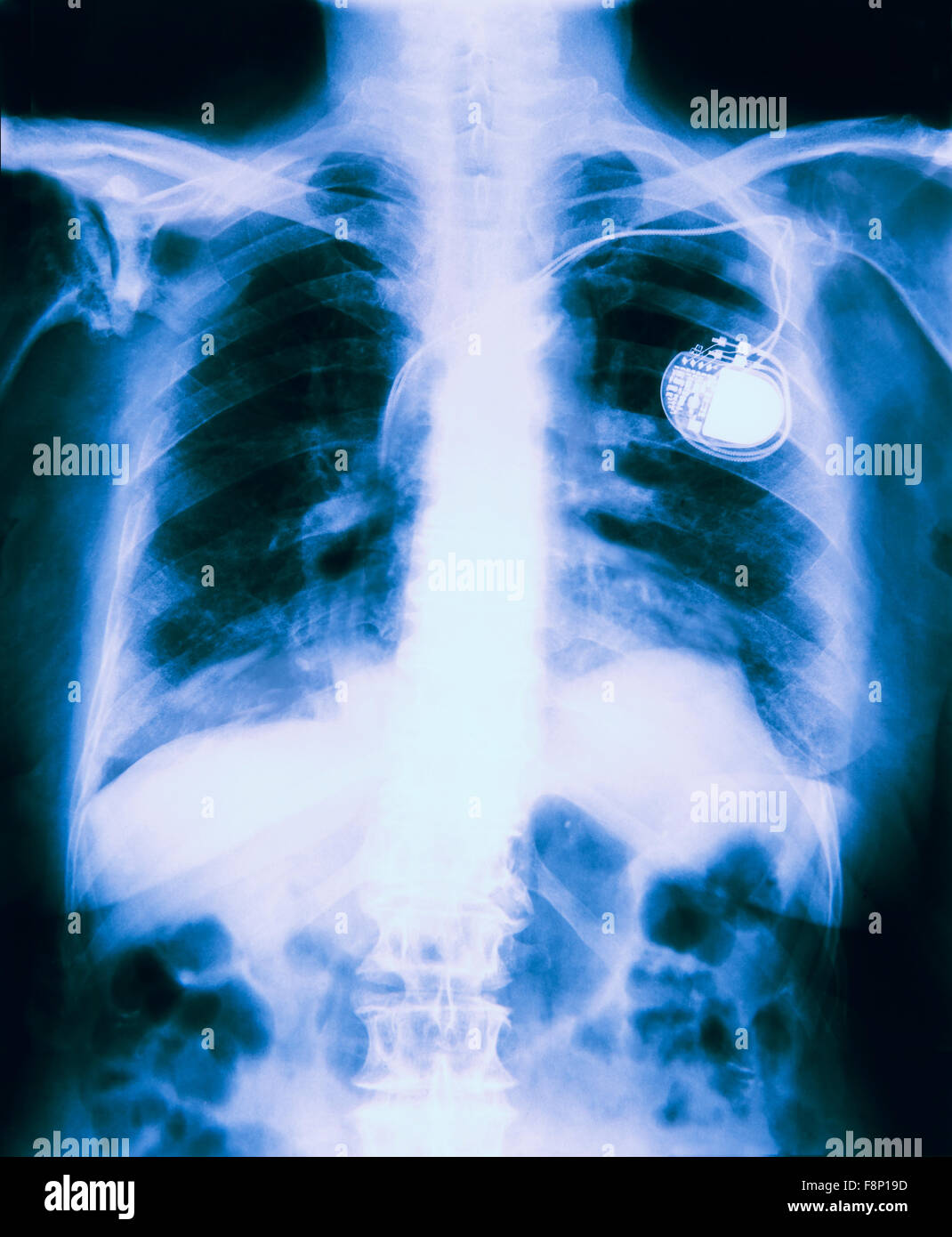 X Ray Of Chest Showing Pacemaker Fitted Stock Photo Alamy