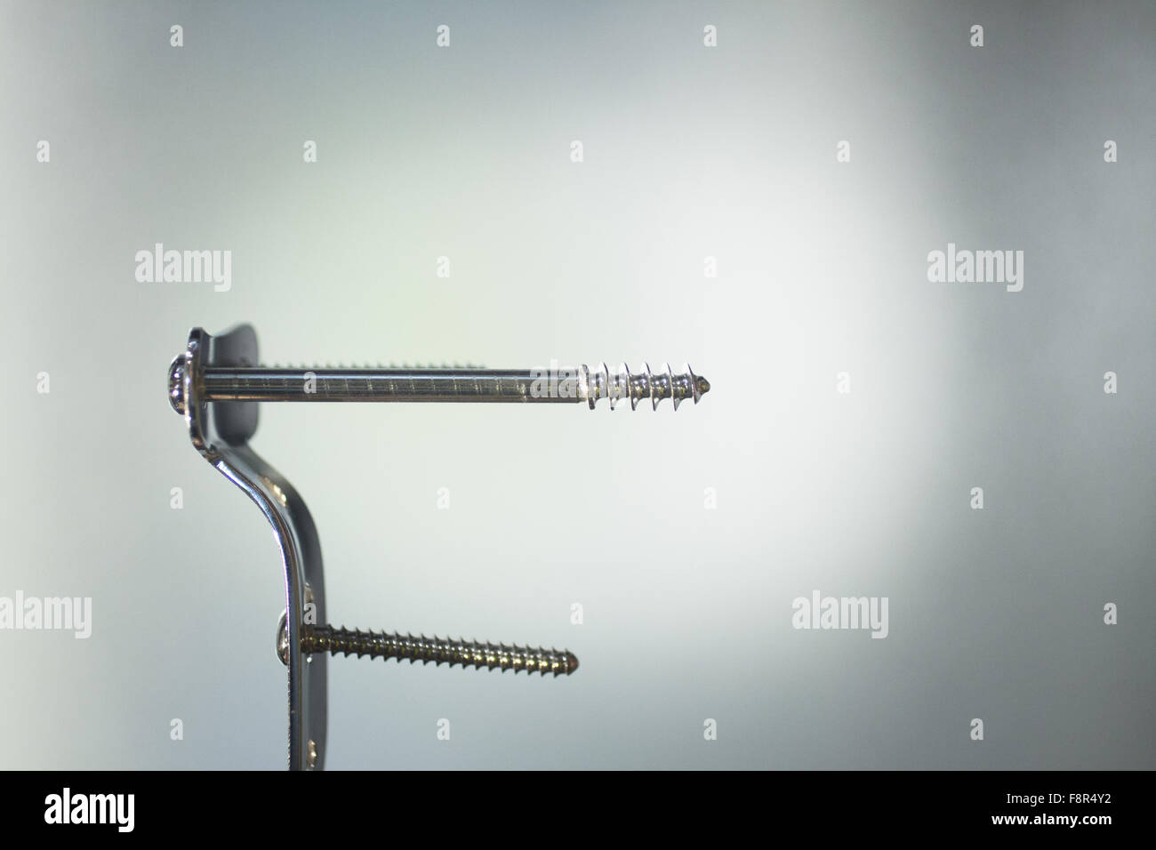 Traumatology and orthopedic surgery implant titanium plate and screws