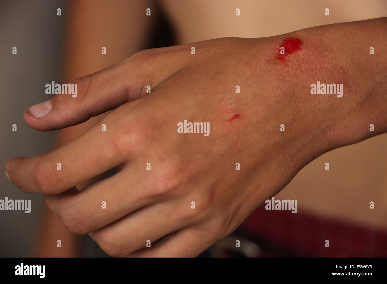 Bleeding Scraped Wrist Stock Photo - Alamy