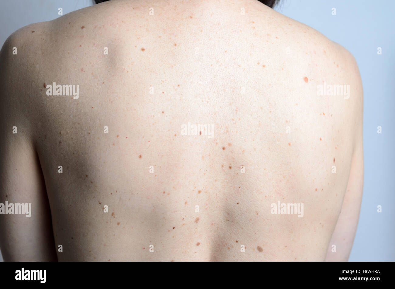 Close up detail of the bare skin on a womans back with scattered moles