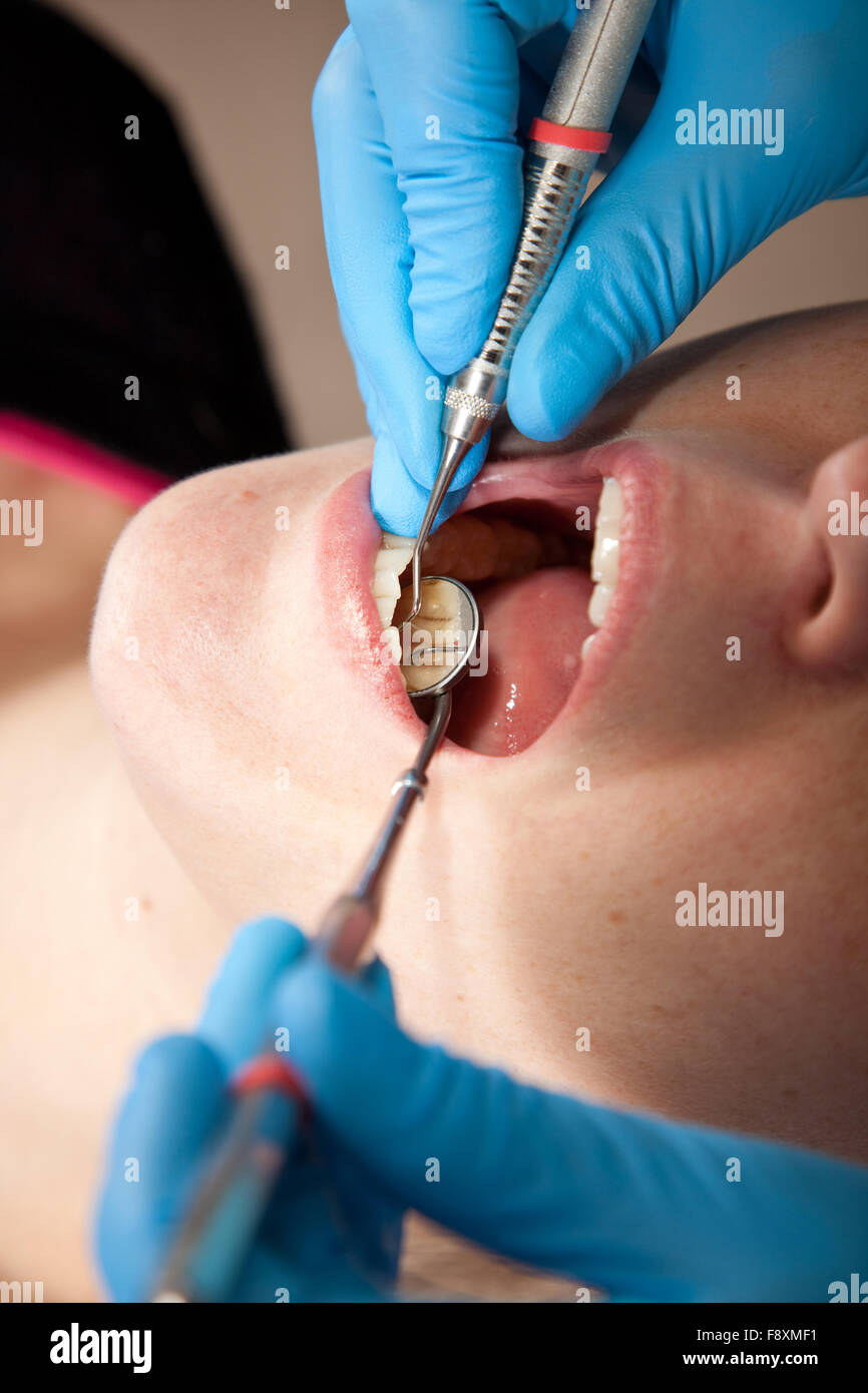 Checking for cavities Stock Photo - Alamy