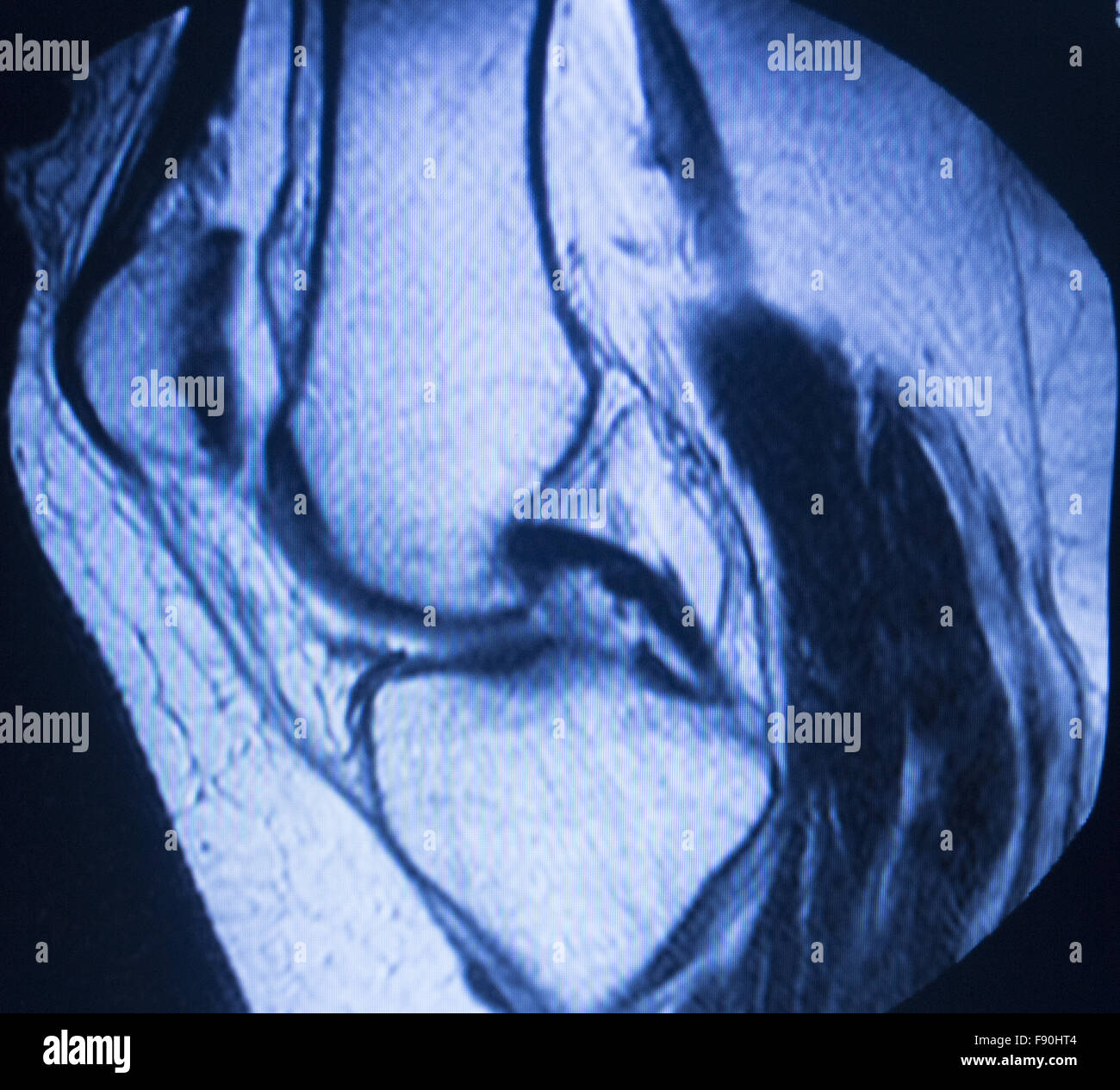 Mekaniker Had vinden er stærk MRI magnetic resonance imaging medical scan test results showing knee  joint, meniscus, femur, thigh and calf of leg, ligaments Stock Photo - Alamy
