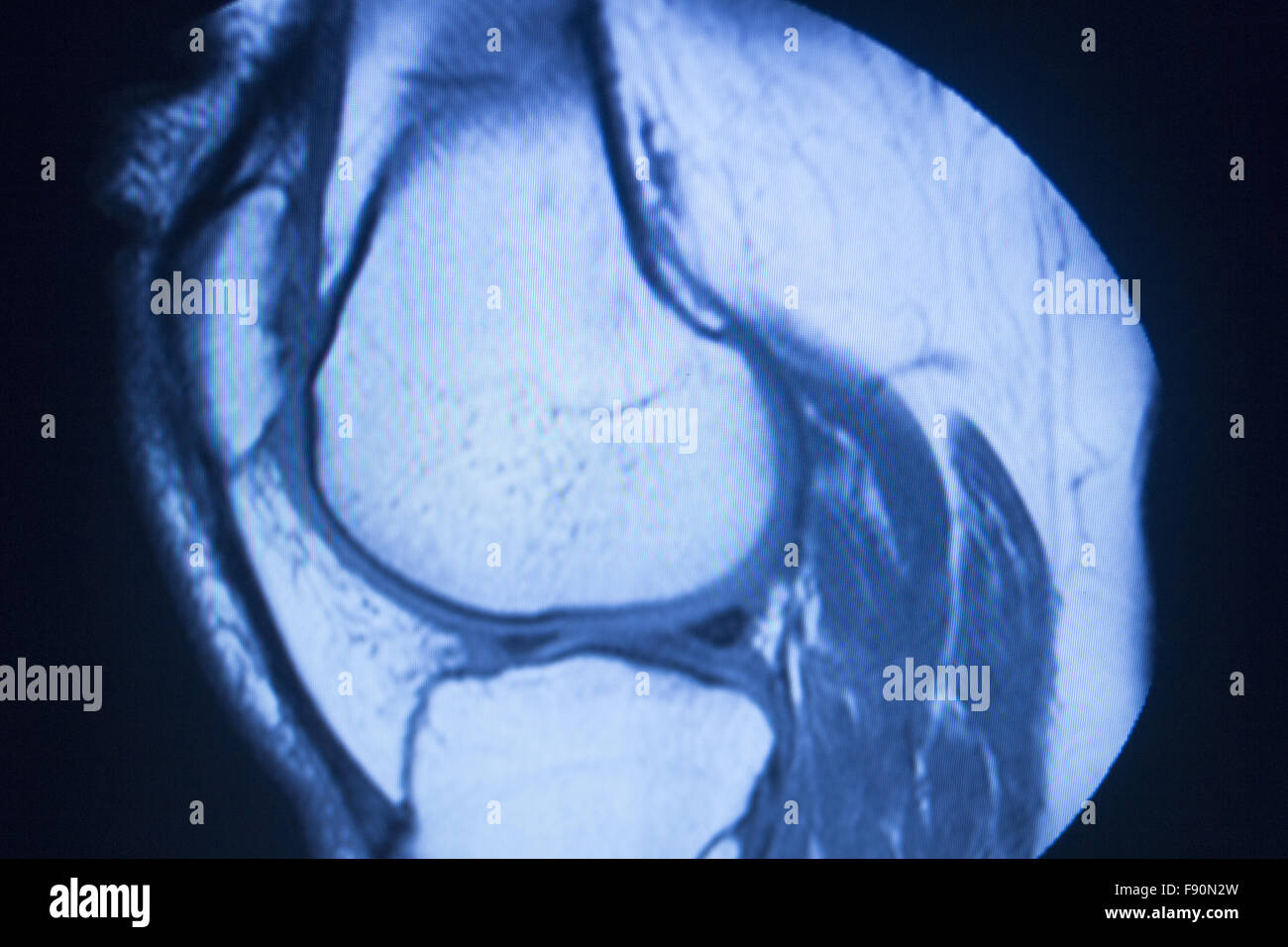 MRI magnetic resonance imaging medical scan test results showing knee ...