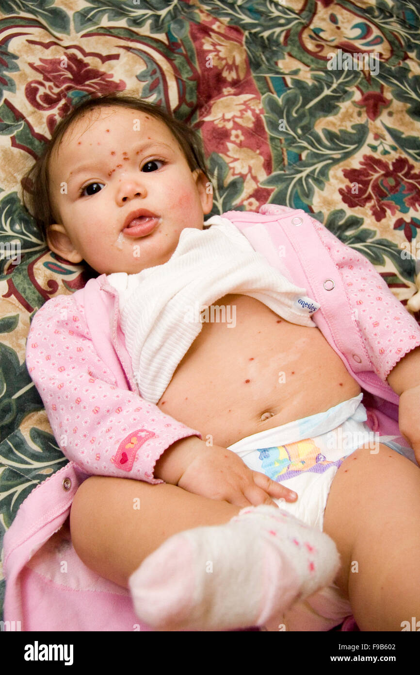 Ten month old girl with chickenpox scabs. Stock Photo
