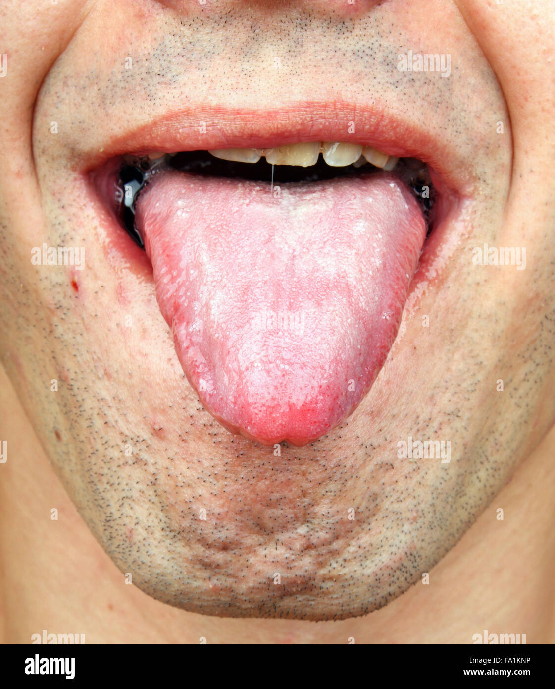 Bacterial infection disease tongue in a  man Stock Photo
