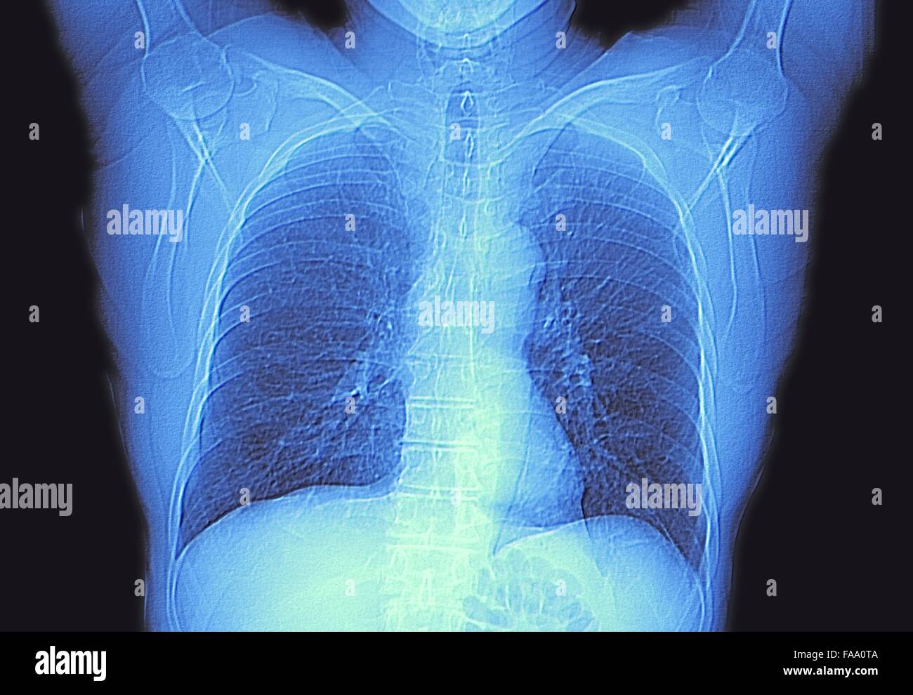 Heart and lungs. Computed tomography (CT) scan of the chest of an healthy adult, showing normal lungs. Stock Photo