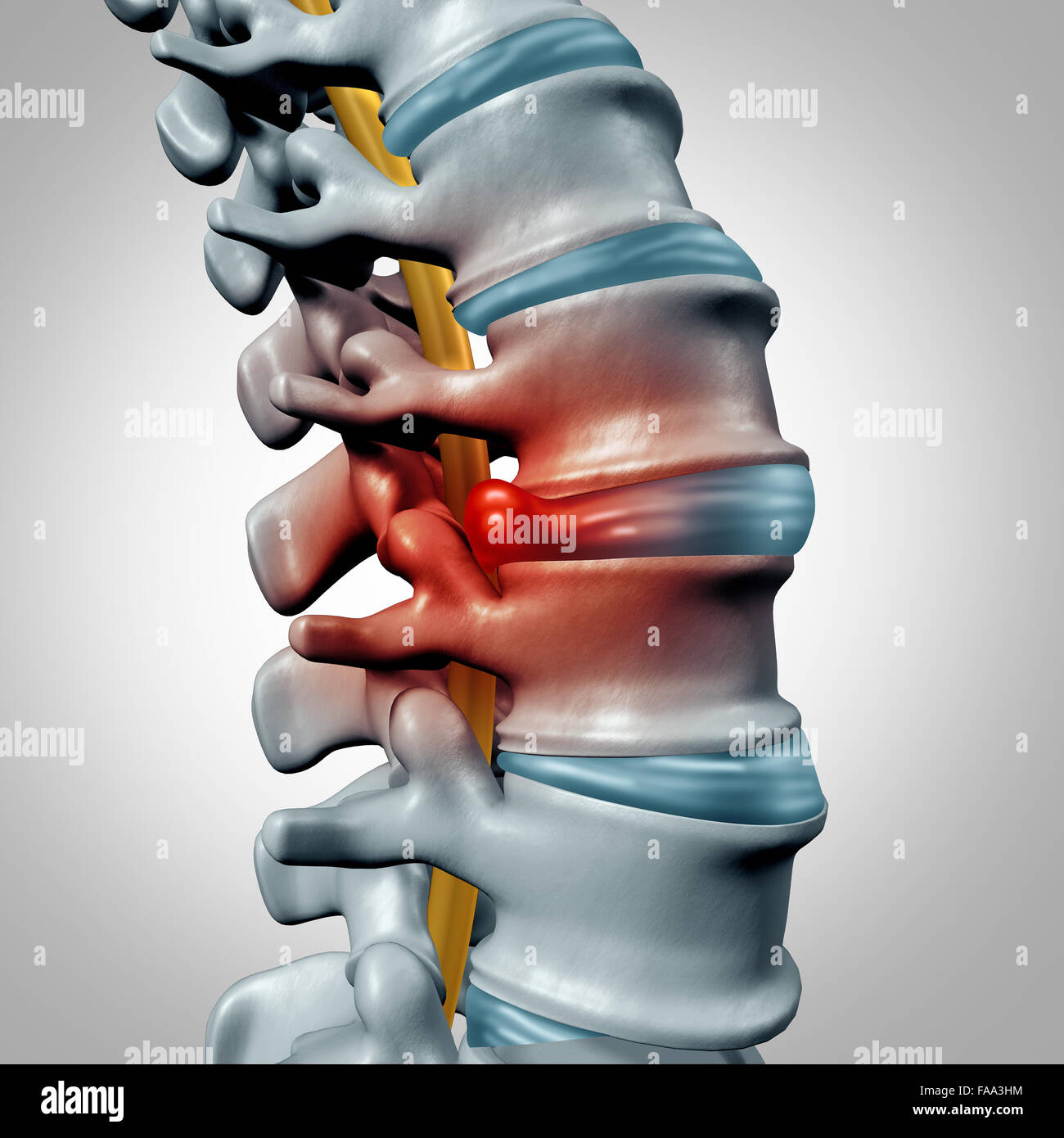 Herniated disk concept and spine pain diagnostic as a human spinal