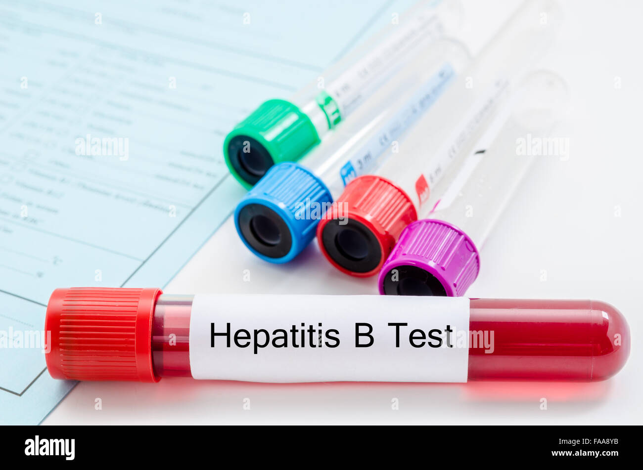 Blood sample for hepatitis B virus (HBV) testing on request form screening test. Stock Photo
