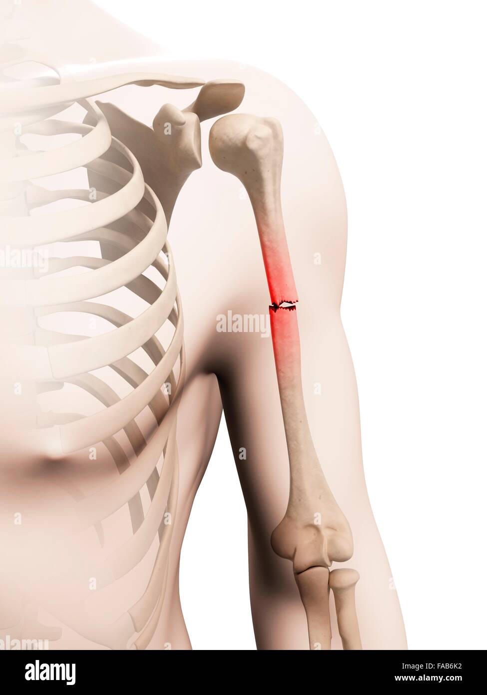 Broken upper arm bone, computer illustration Stock Photo Alamy