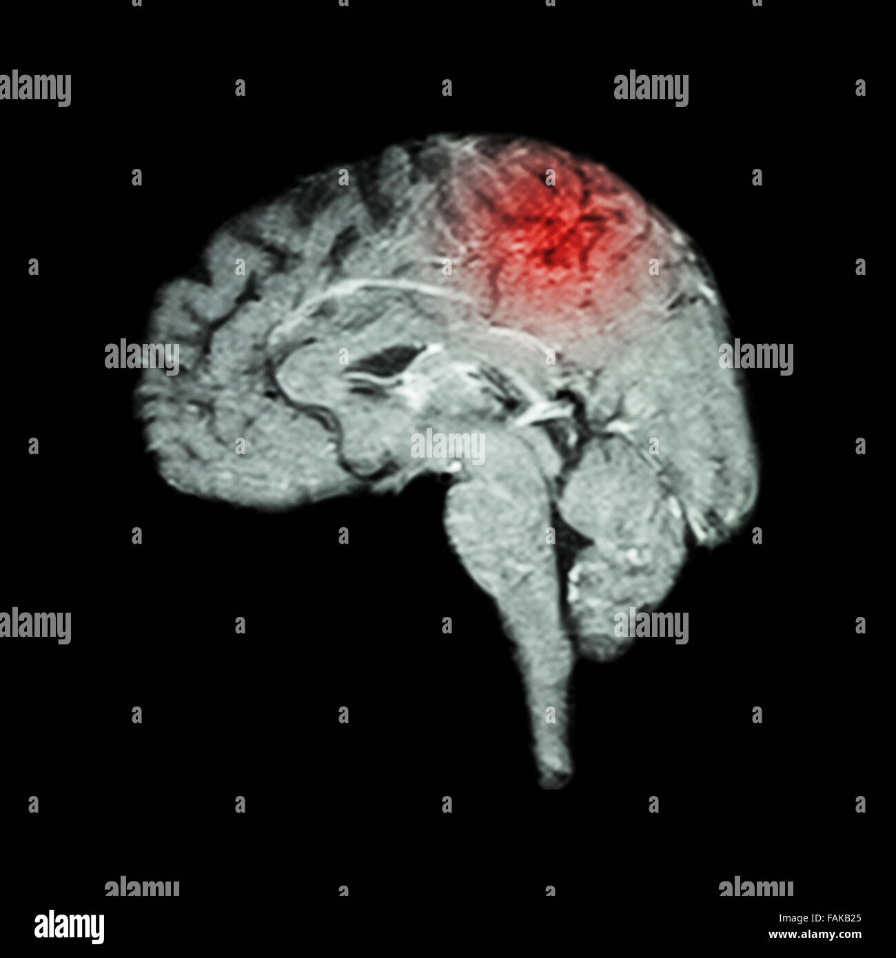Resonance Imaging ( MRI ) of brain and Stroke ( Medical
