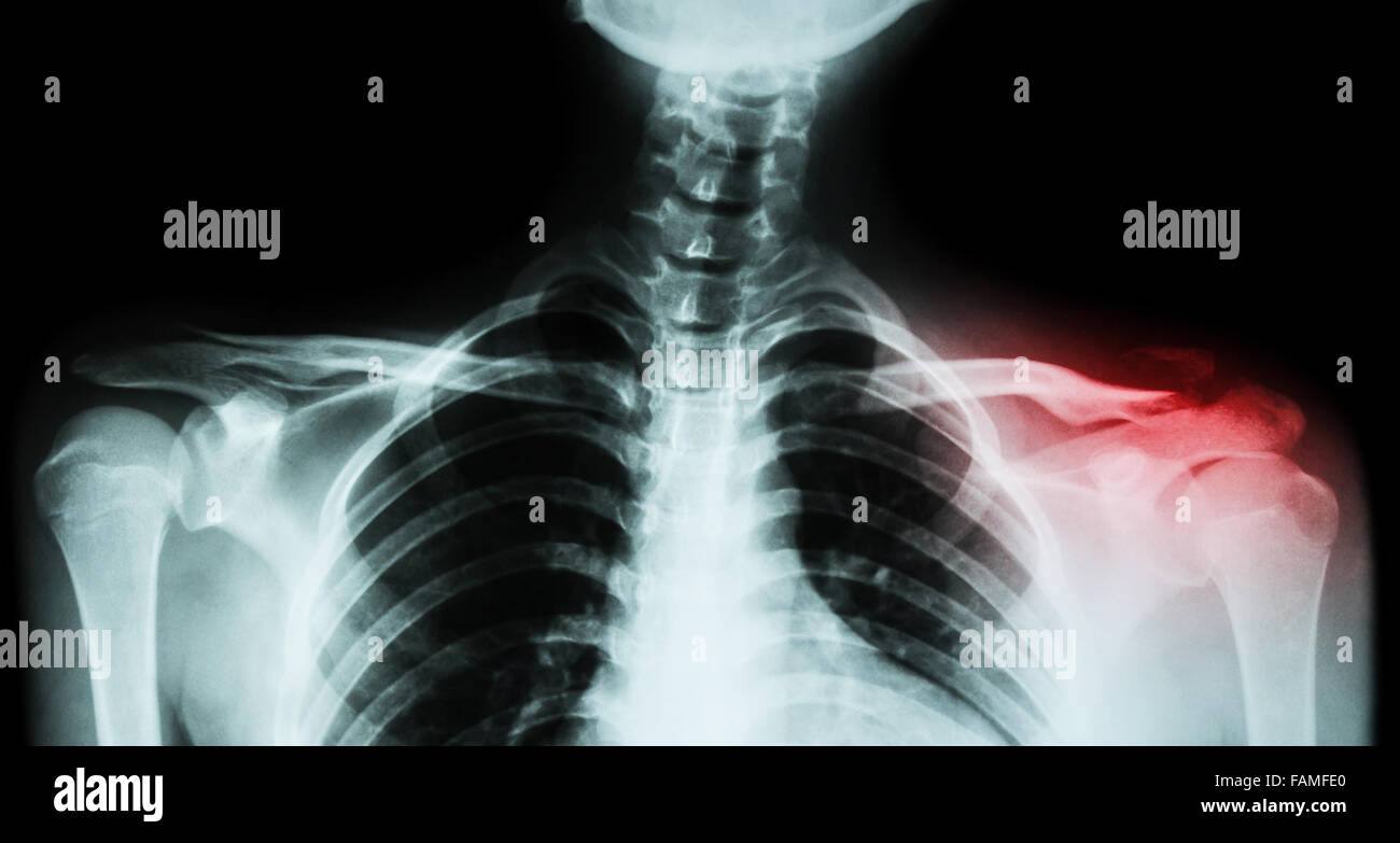 Film xray both clavicle AP ( front view ) show fracture distal left
