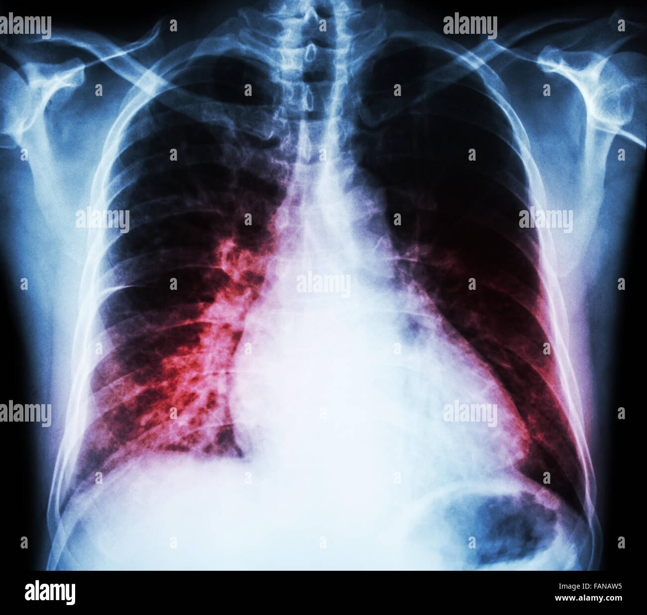 Heart failure ( film xray chest PA upright show cardiomegaly and