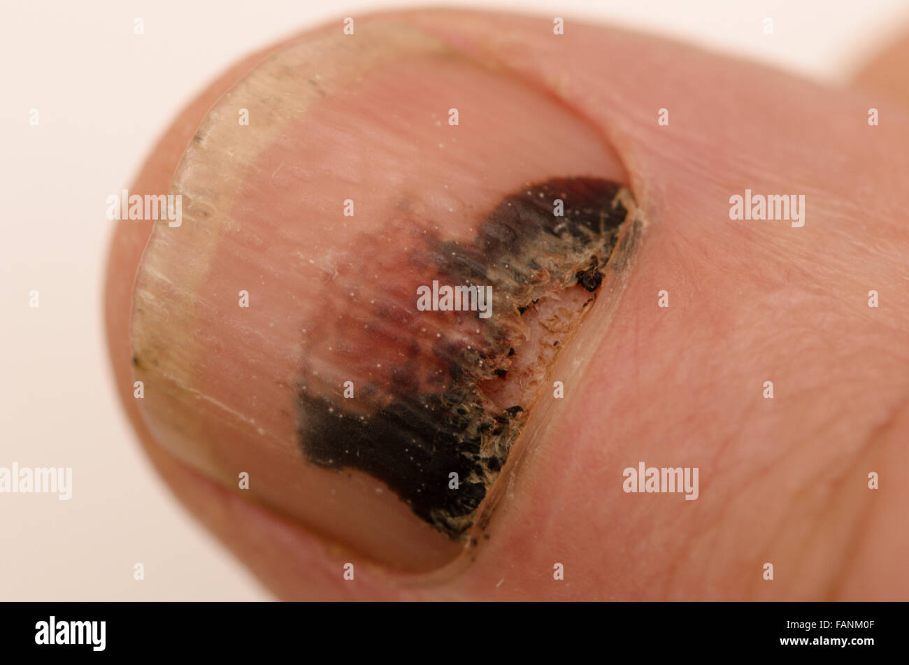 Is this finger nail fungus ? The black spot on my middle finger (also  discolored ) : r/NailFungus