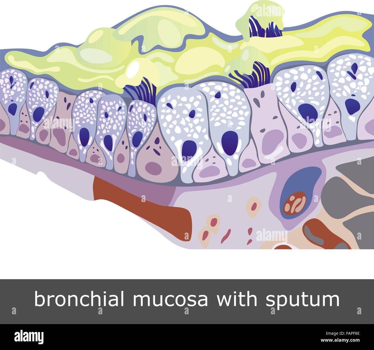 Structure of damaged bronchial mucosa with sputum, vector illustration Stock Vector