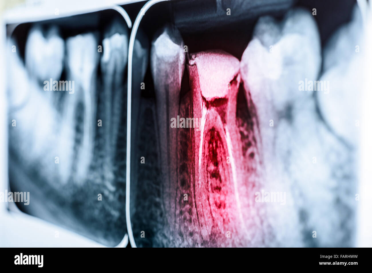 Pain Of Tooth Decay On Teeth X-Ray Stock Photo