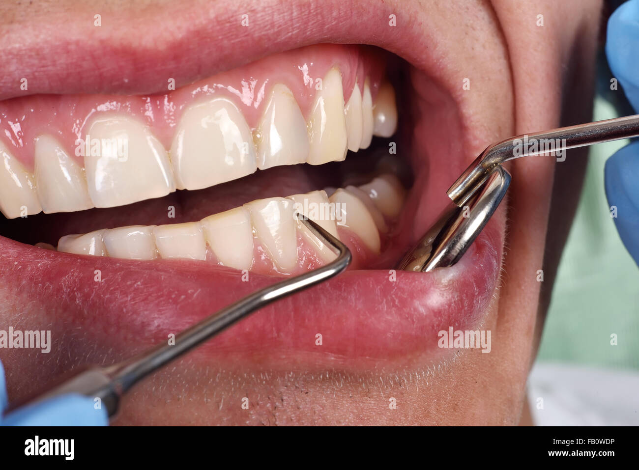 patient open mouth before oral inspection with hook and mirror Stock