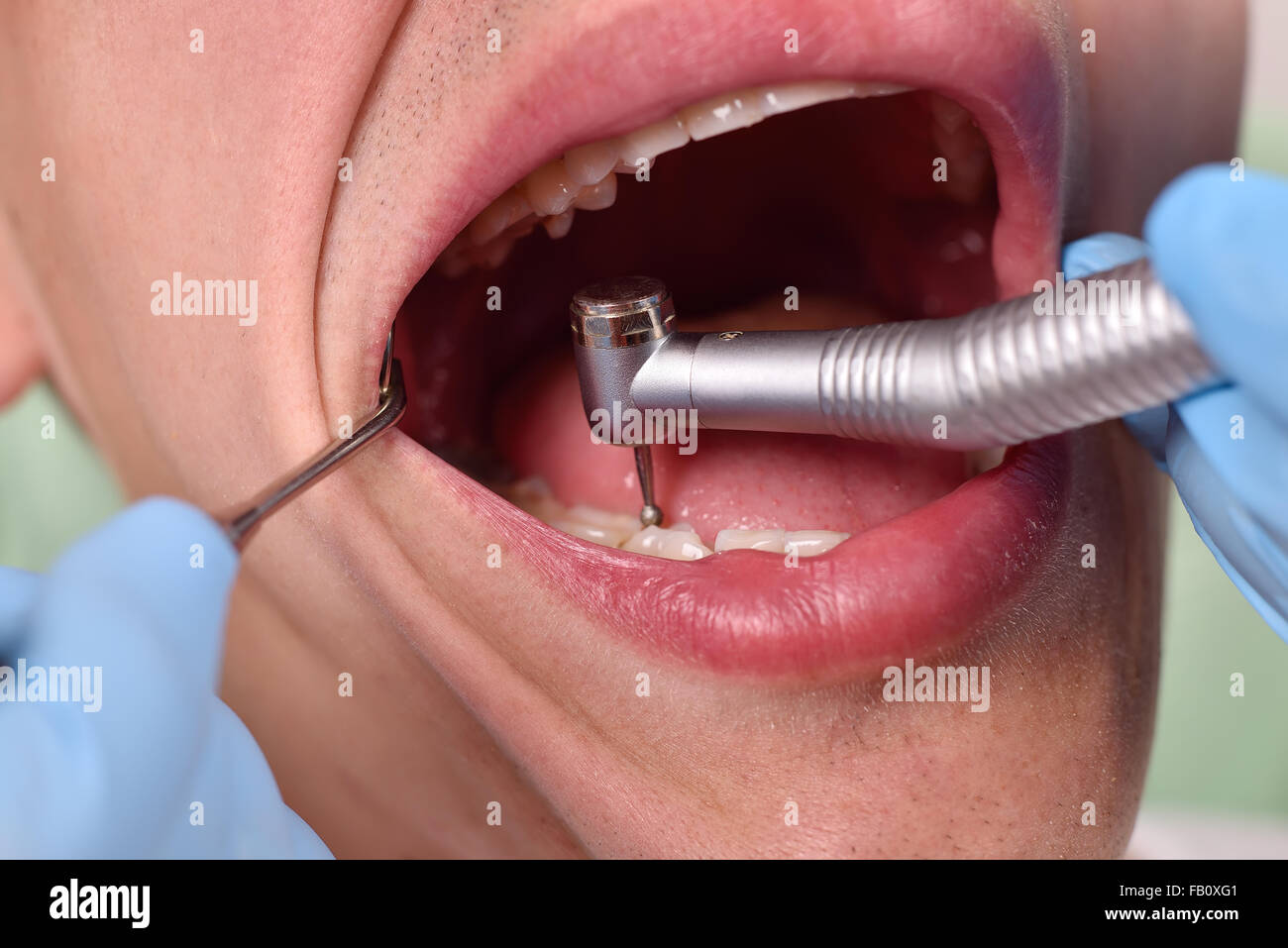 close up a dentist using dental drill and mouth mirror Stock Photo - Alamy