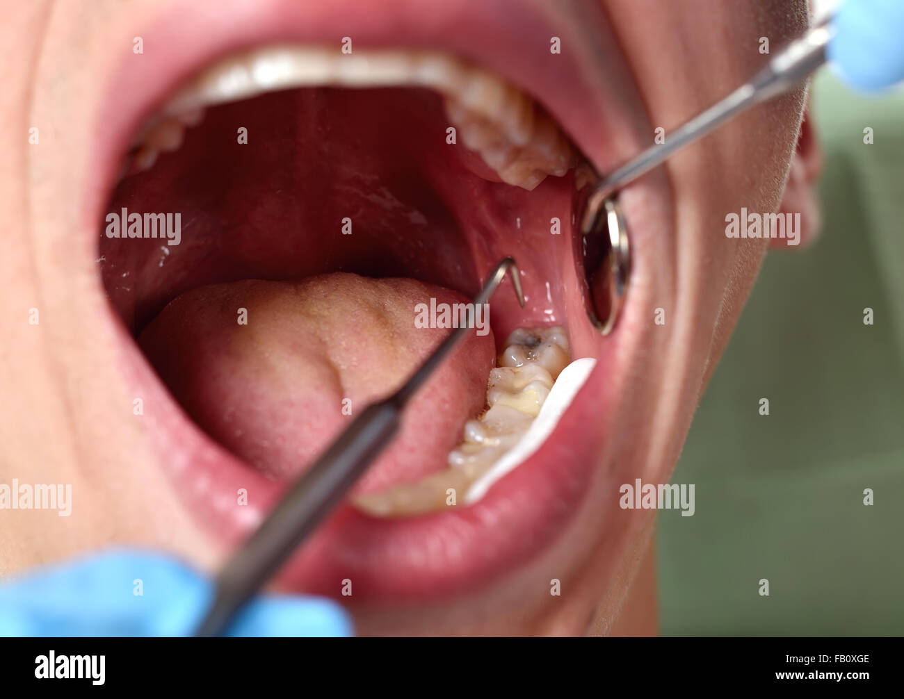 patient open mouth before oral inspection with hook and mirror Stock