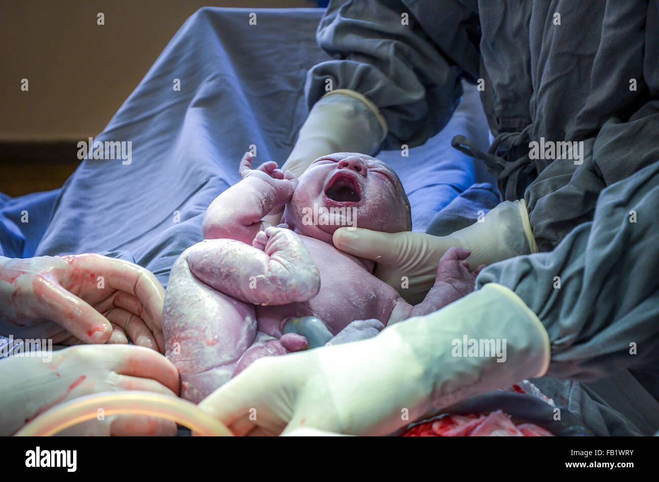 C section. Surgical team performing surgery operation in maternity hospital. Stock Photo