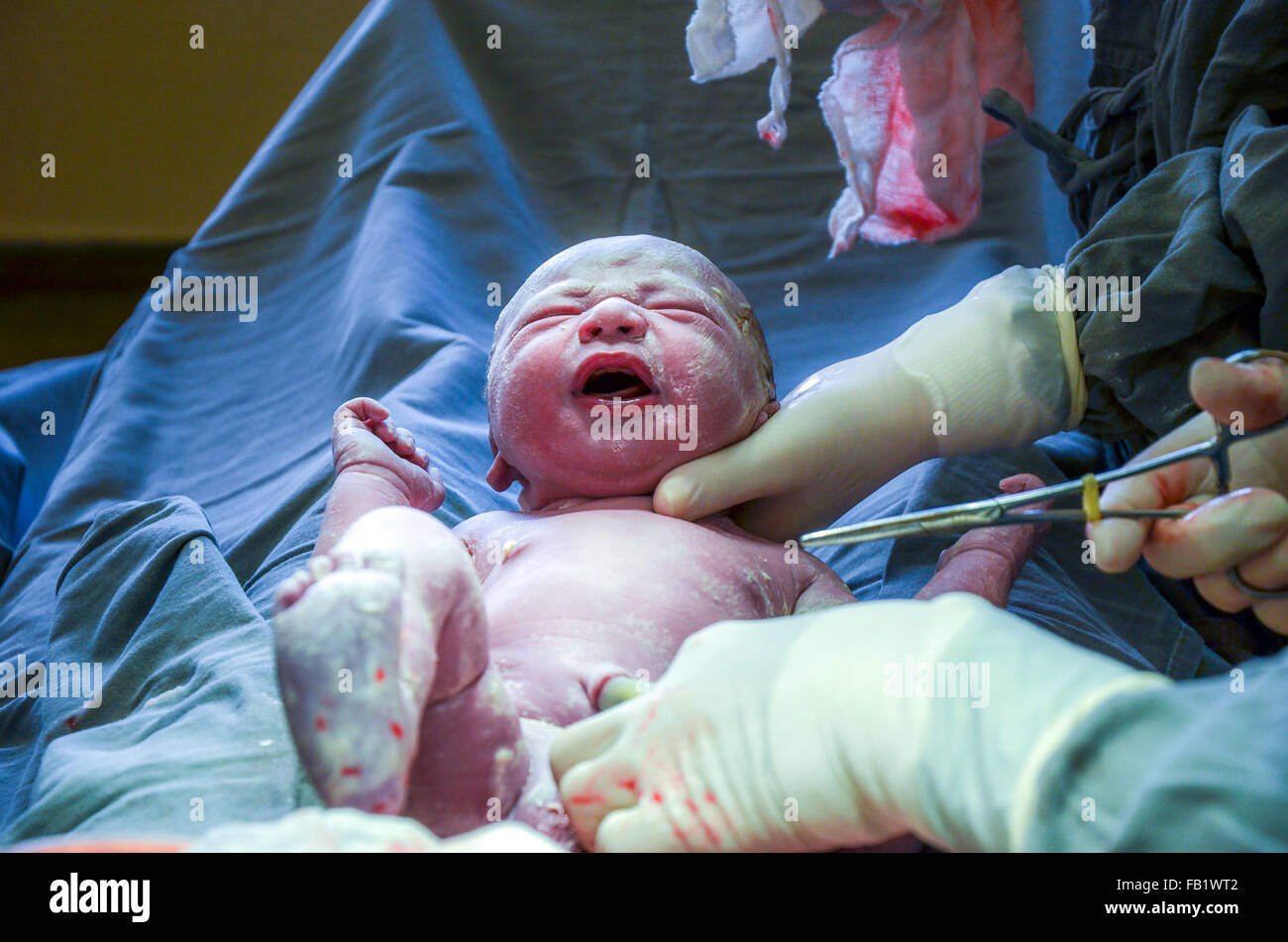 C section. Surgical team performing surgery operation in maternity hospital. Stock Photo