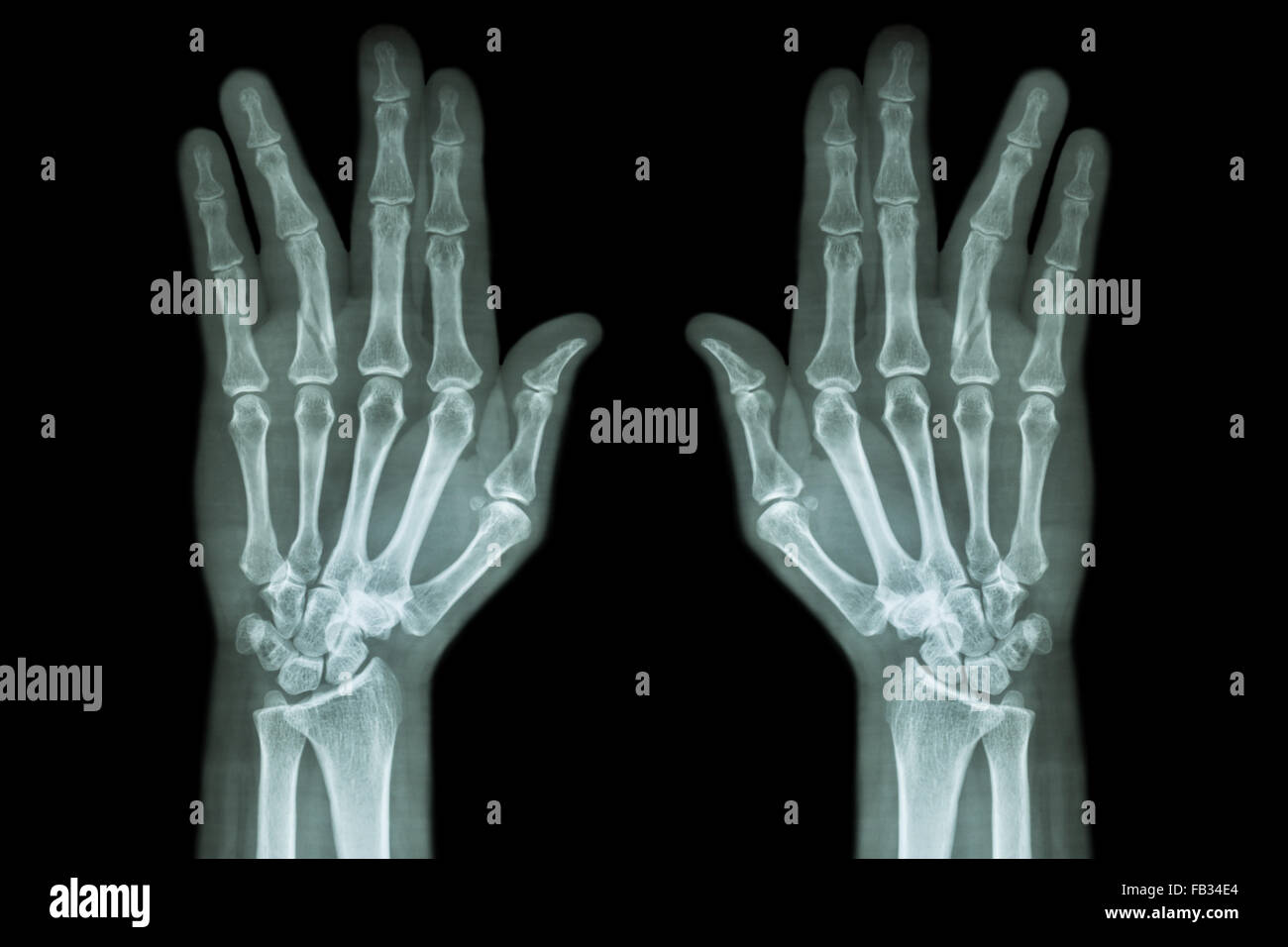 Fracture shaft of proximal phalange of ring finger ( film xray both