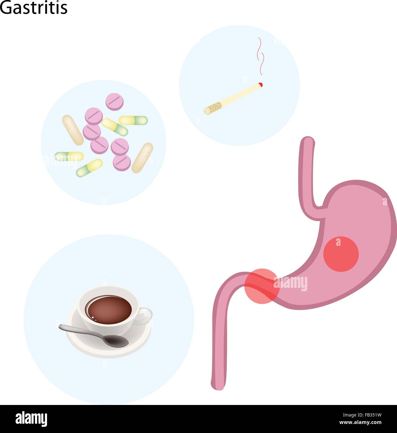 Medical Concept, Illustration of Gastritis Can Be Caused by Excessive Alcohol, Caffein, Nicotine, Chronic Vomiting, Stress and C Stock Vector