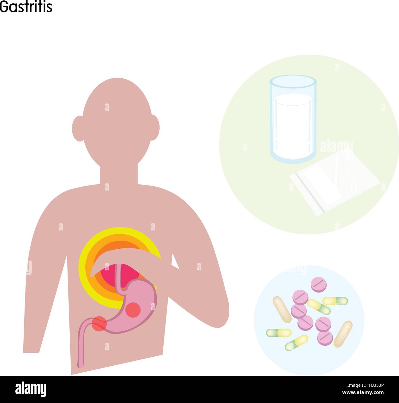 Medical Concept, Illustration of Gastritis Caused by Excessive Alcohol, Caffein, Nicotine, Chronic Vomiting, Stress and Certain Stock Vector