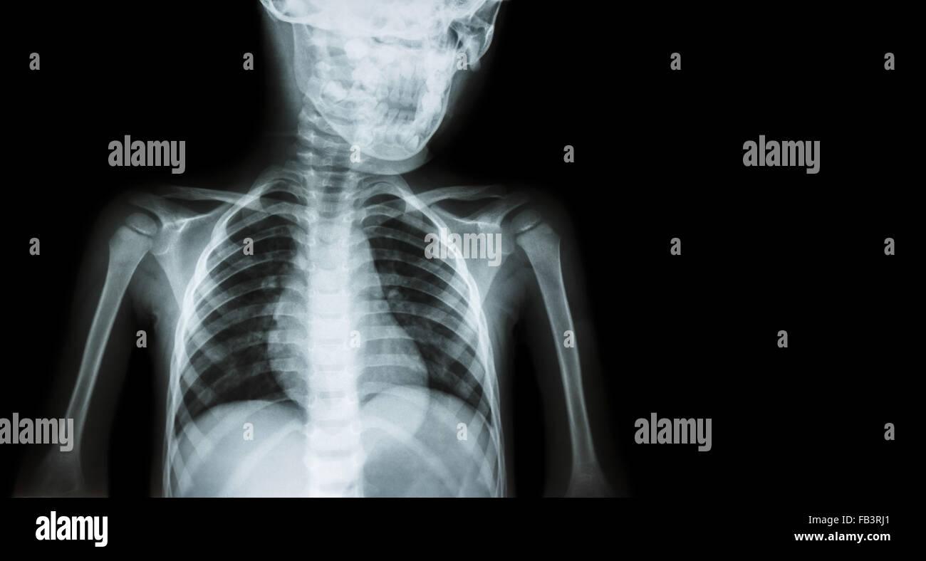Film x-ray body of child and blank area at right side ( Medical background ) Stock Photo