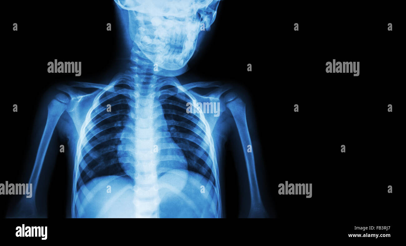 Film x-ray body of child and blank area at right side ( Medical background ) Stock Photo
