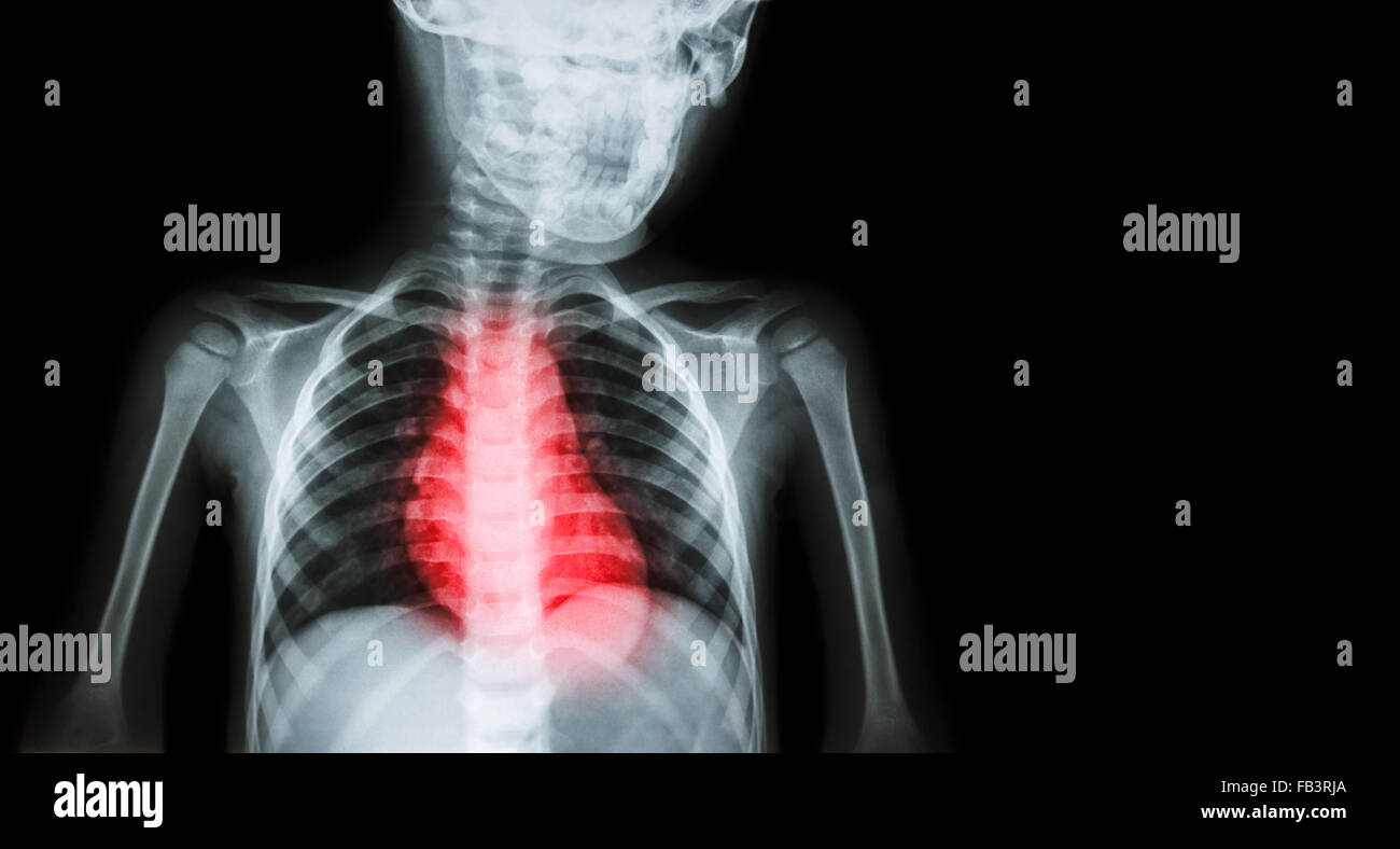 Ischemic Heart Disease , Myocardial Infarction ( MI ) ( Film x-ray body of human with heart disease and blank area at right side Stock Photo