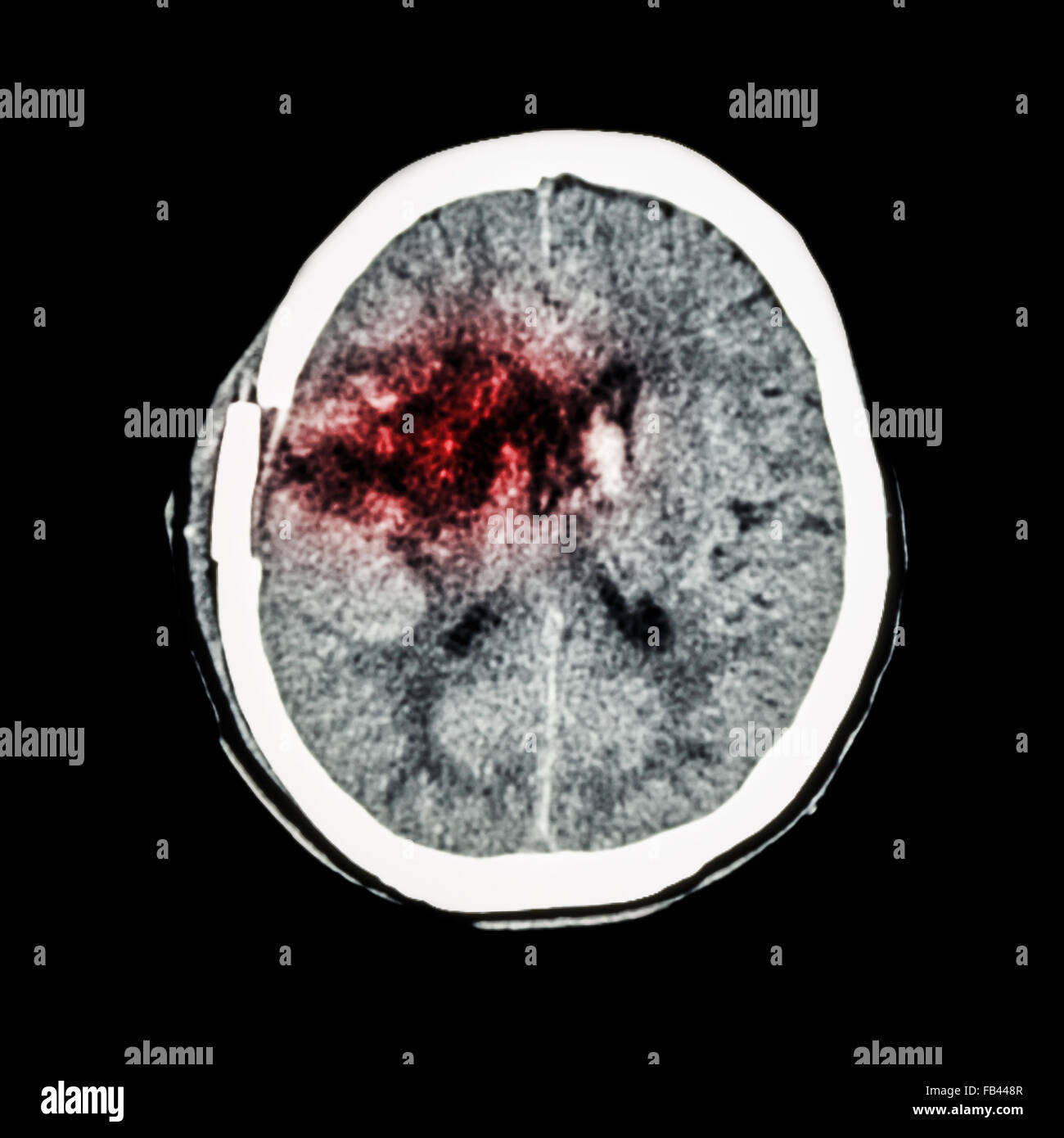 CT scan of brain : show old right basal ganglia hemorrhage with brain edema ( status post craniotomy ) ( Hemorrhagic stroke ) Stock Photo