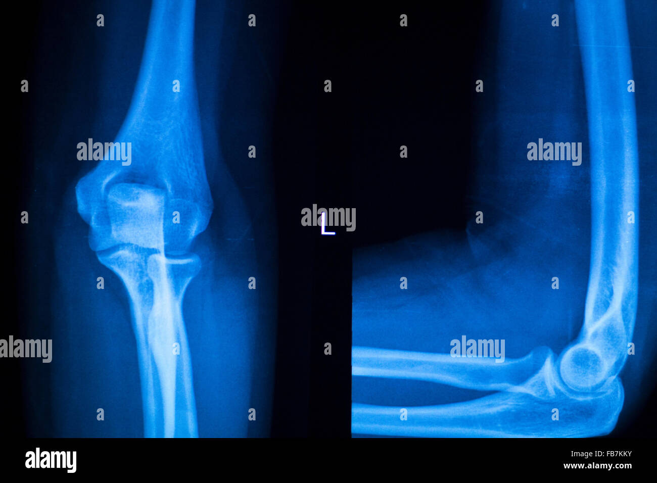 Othopedics and Traumatology surgical implant arm and elbow xray test