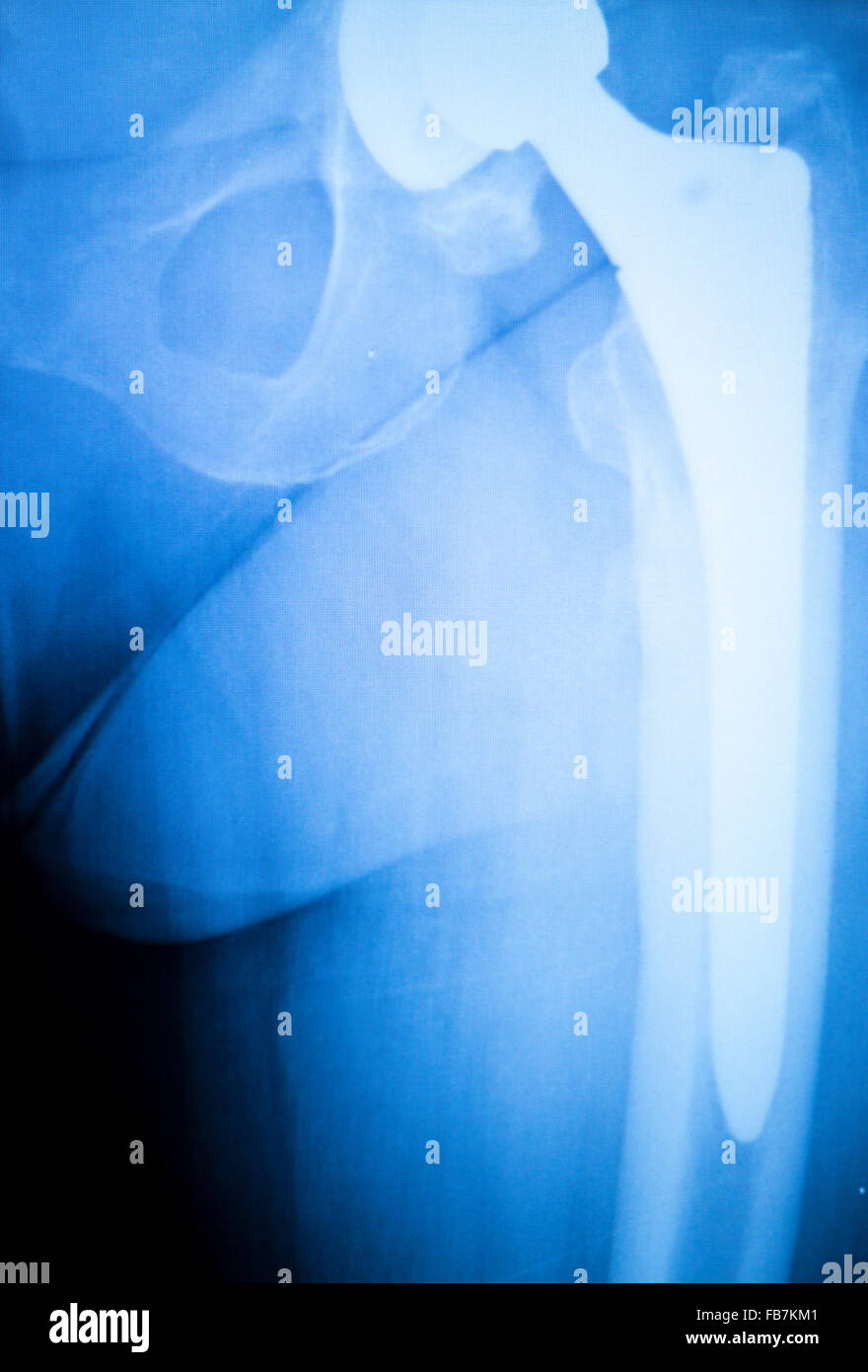 Arthritic hip xray test scan orthopedic and Traumatology results