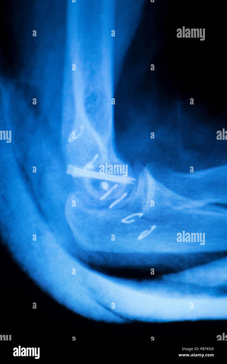 Othopedics and Traumatology surgical implant arm and elbow xray test