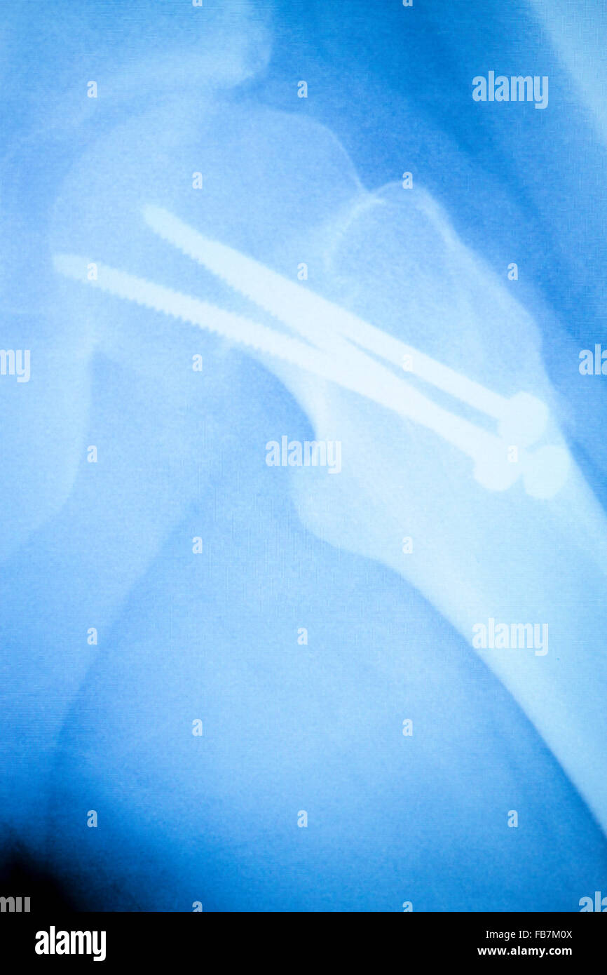 Arthritic hip xray test scan orthopedic and Traumatology results