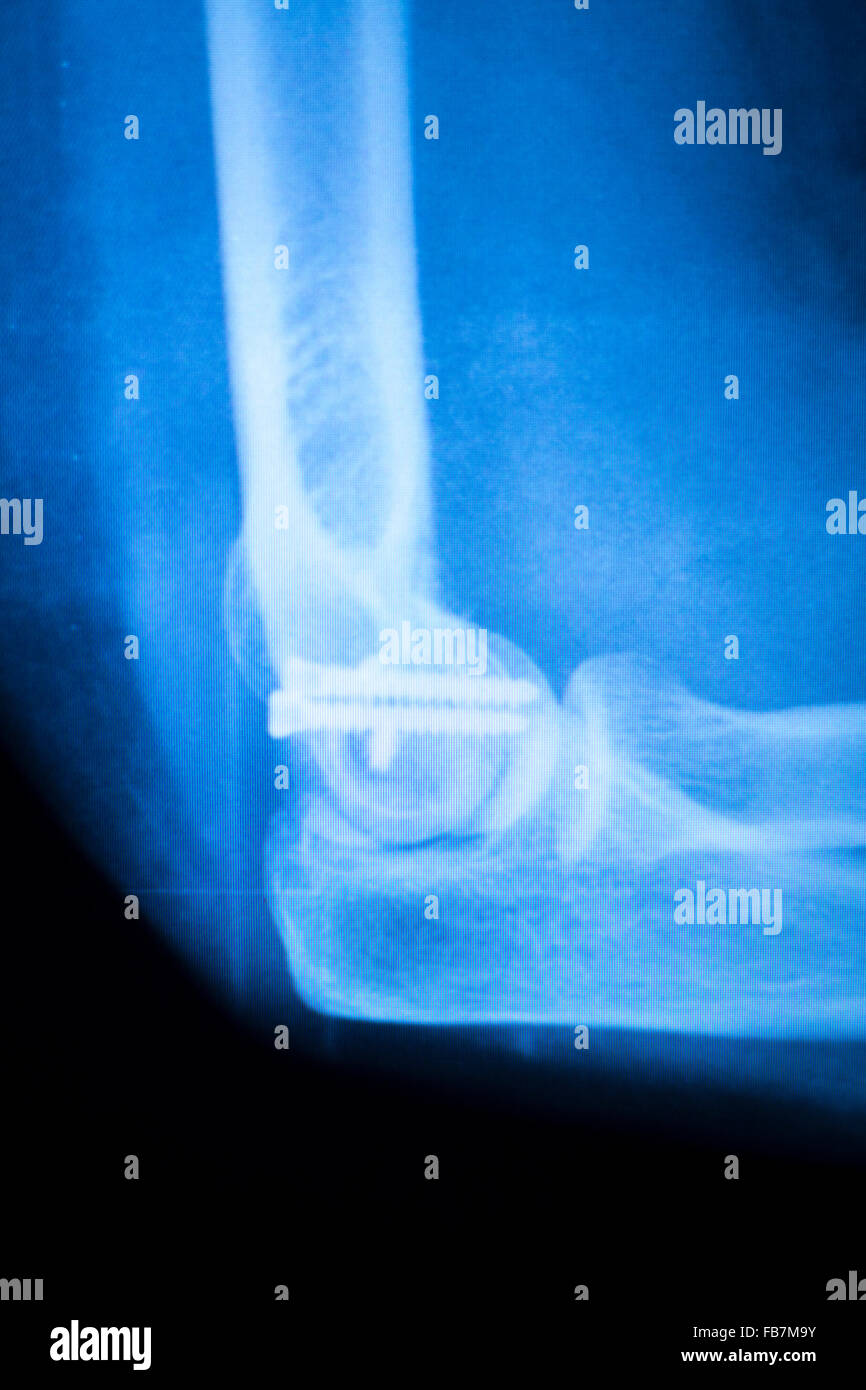 Othopedics and Traumatology surgical implant arm and elbow xray test