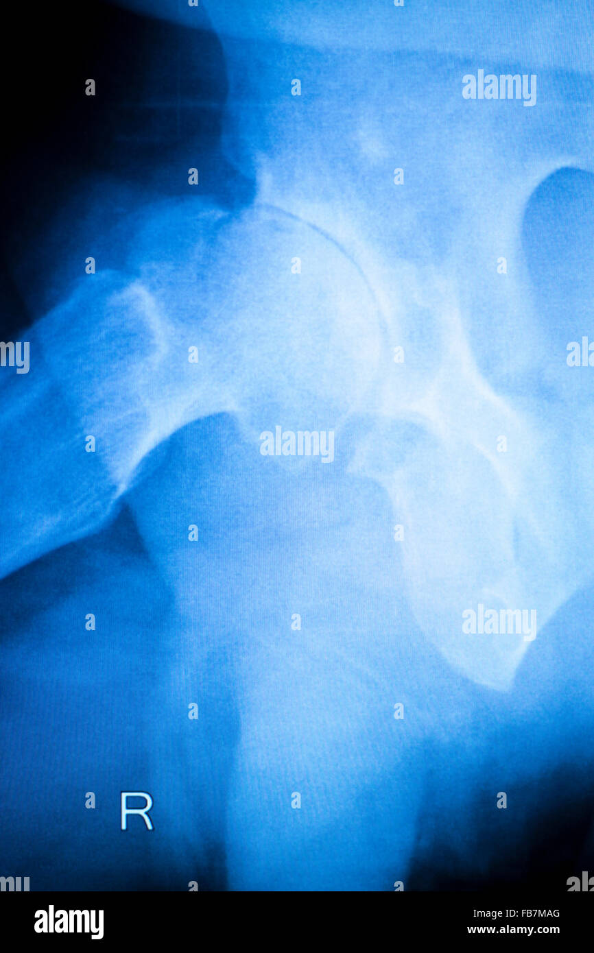 Arthritic hip xray test scan orthopedic and Traumatology results Stock