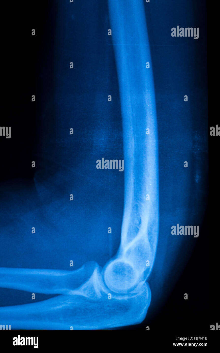 Othopedics and Traumatology surgical implant arm and elbow xray test
