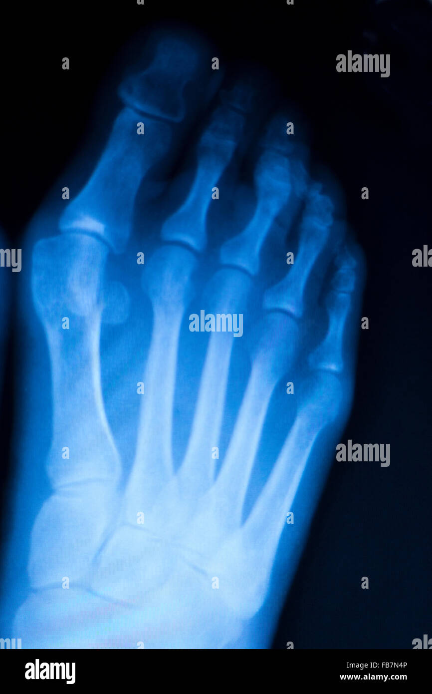 Foot and toes injury xray scan orthopedics and Traumatology radiology