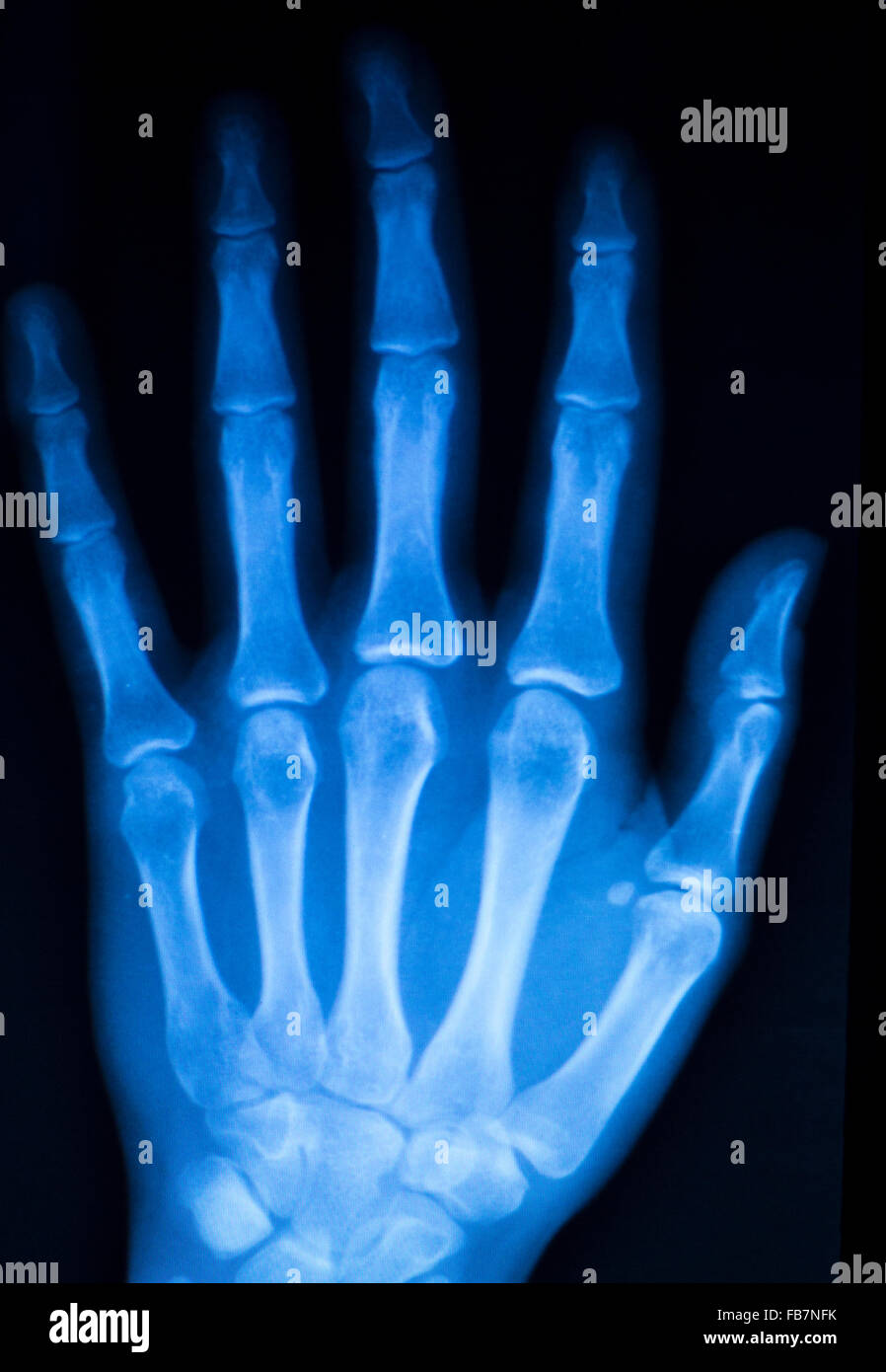 Hand, fingers and thumb hospital xray scan test results for joint pain