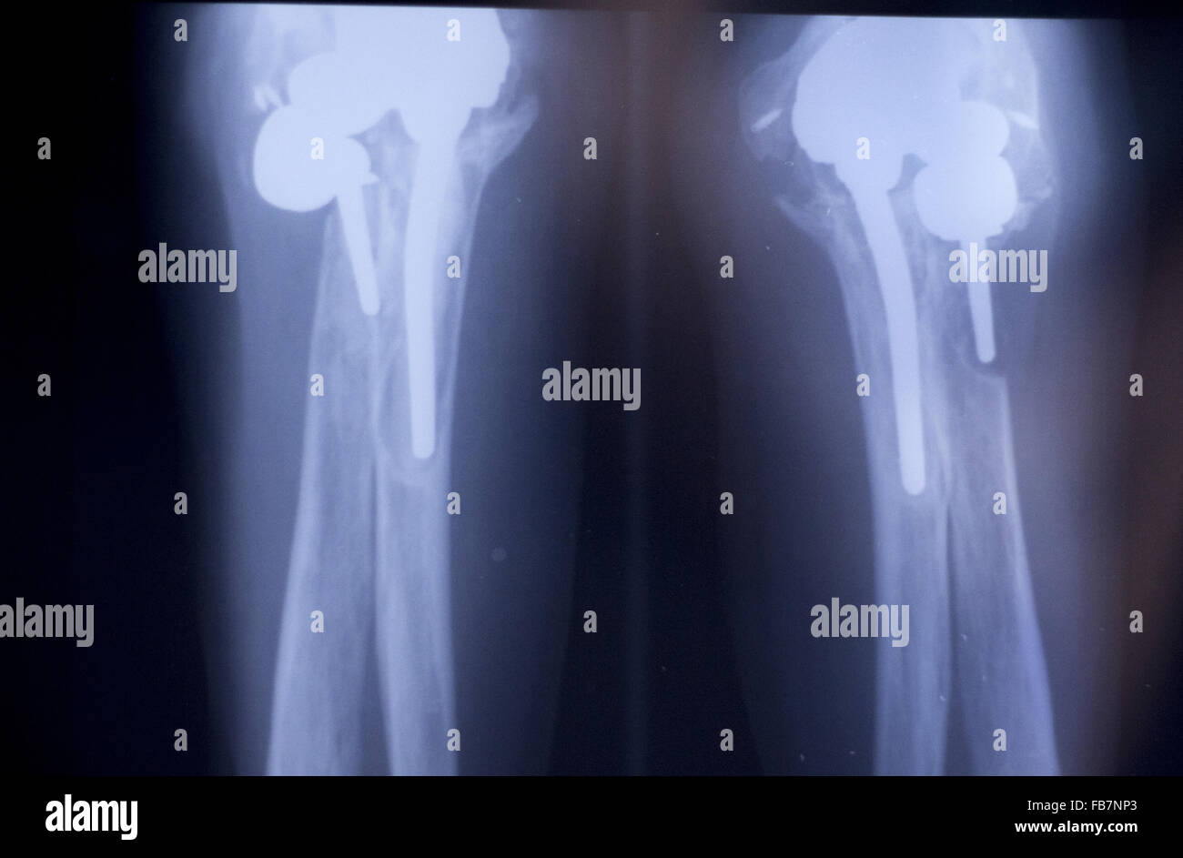 Othopedics and Traumatology surgical implant arm and elbow xray test