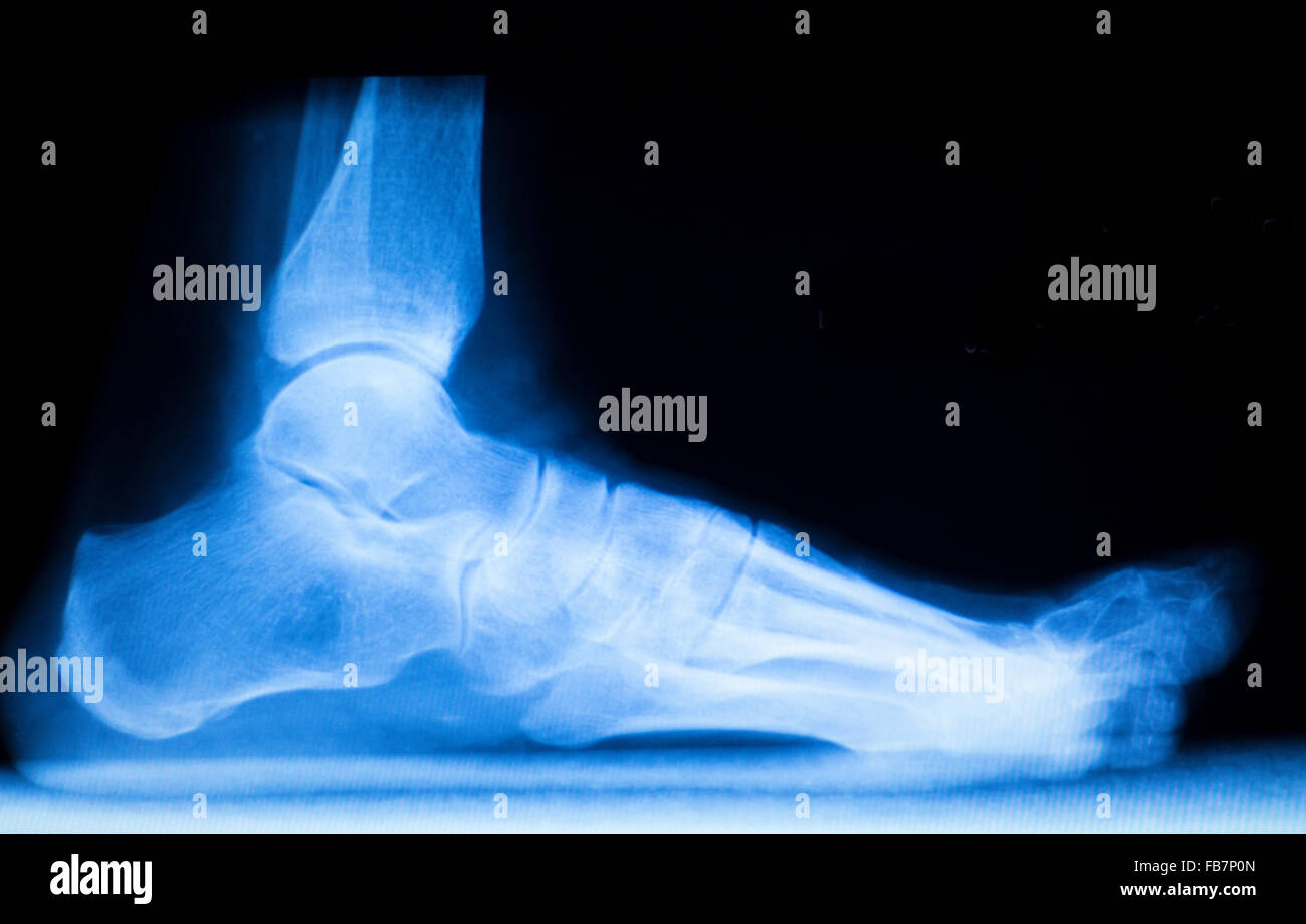 Foot and toes injury xray scan orthopedics and Traumatology radiology