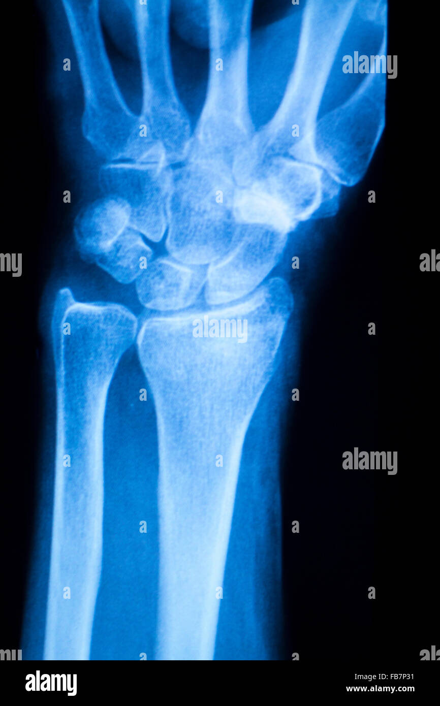 Hand, fingers and thumb hospital xray scan test results for joint pain