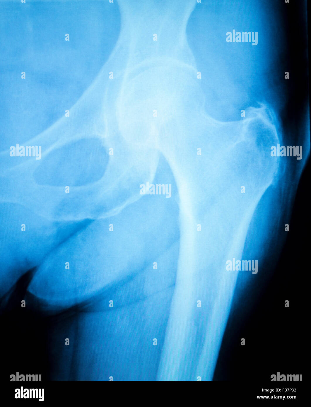 Arthritic hip xray test scan orthopedic and Traumatology results Stock