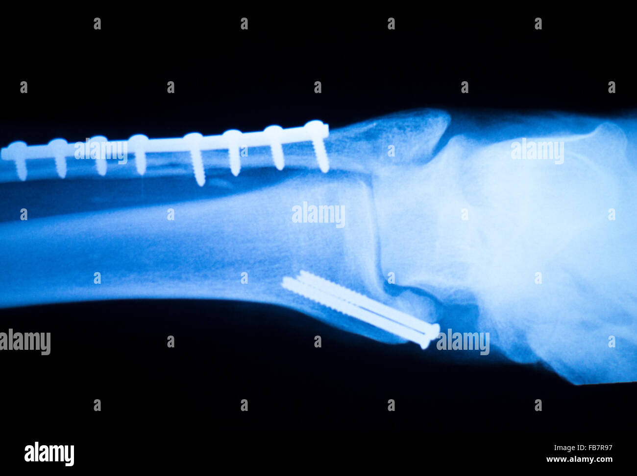 Foot ankle and shin orthopedics xray scan results showing Traumatology